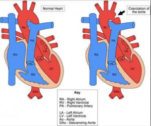 Coarctation of Aorta